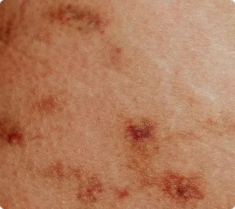 Psoriasis Treatment in Besant Nagar